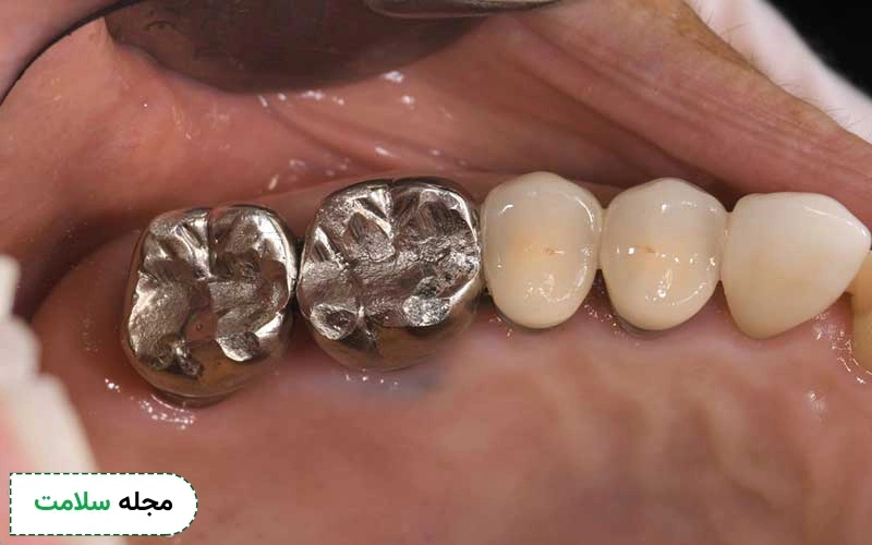 روکش استیل دندان چه مزایا و معایبی دارد؟ کاربرد آن برای دندان شیری و دائمی چیست؟