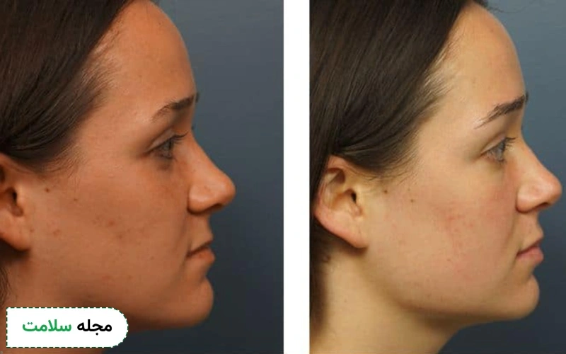 نحوه انجام زاویه سازی فک با نخ چگونه است؟