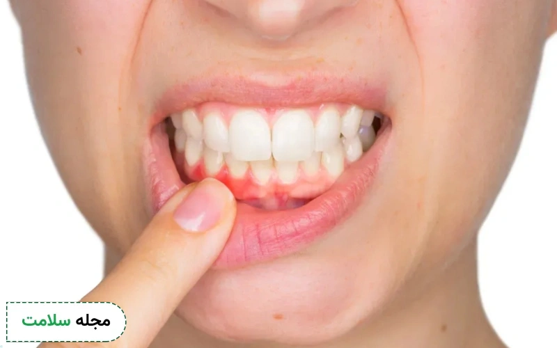 مراحل پیشگیری از تحلیل لثه در بارداری چیست؟