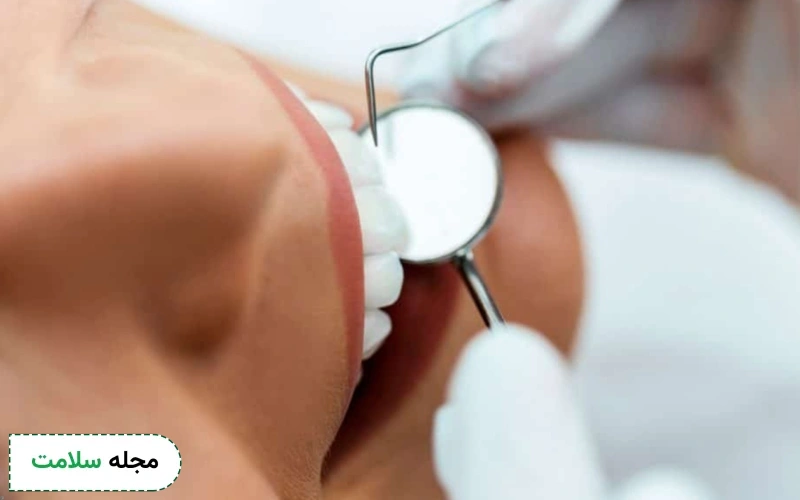علت ممنوع شدن سیگار بعد از لمینت چیست؟