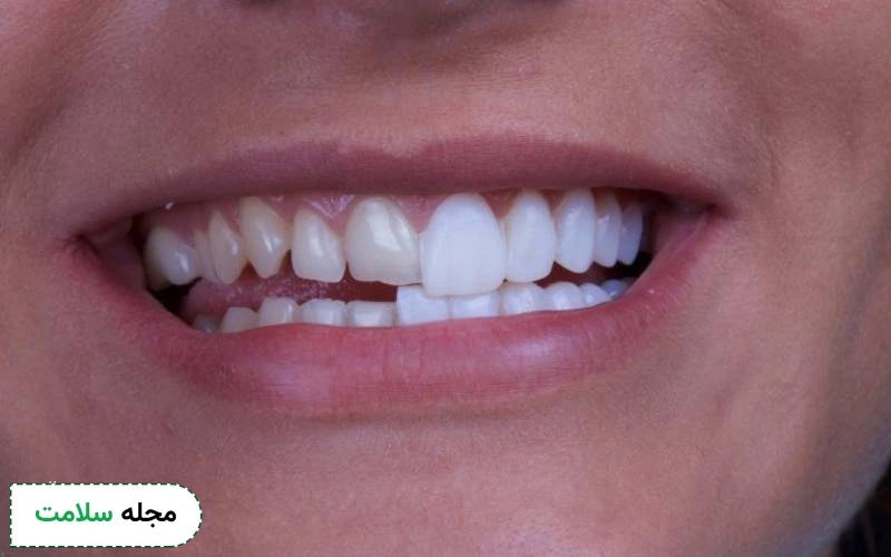 لمینت کریستالی برای چه افرادی مناسب است؟ مزایا و عوارض آن چیست؟