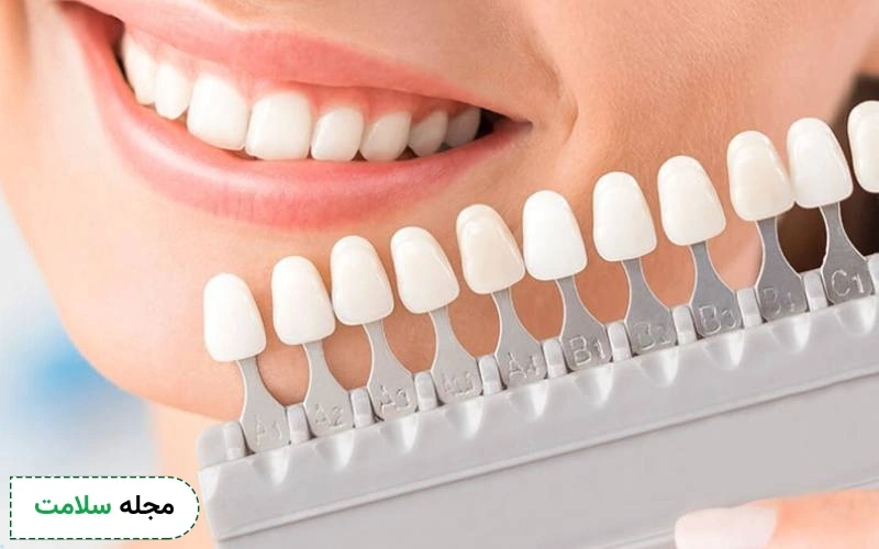 لمینت سرامیکی فوق نازک