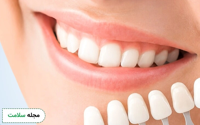 چه کسانی باید از لمینت استفاده کنند؟