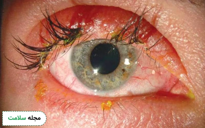 روش های پیشگیری از عوارض کاشت مژه