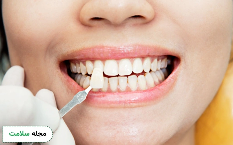 نحوه تعویض لمینت دندان چگونه است؟