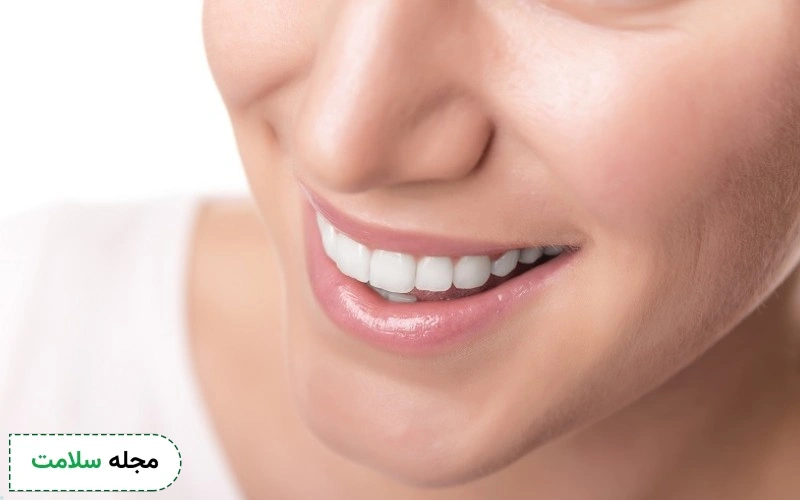مزایای این نوع لمینت