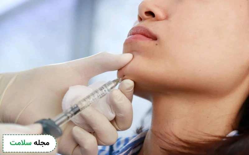  تزریق بوتاکس برای زاویه سازی صورت معمولا در ماهیچه جونده یا ماستر انجام می‌شود.