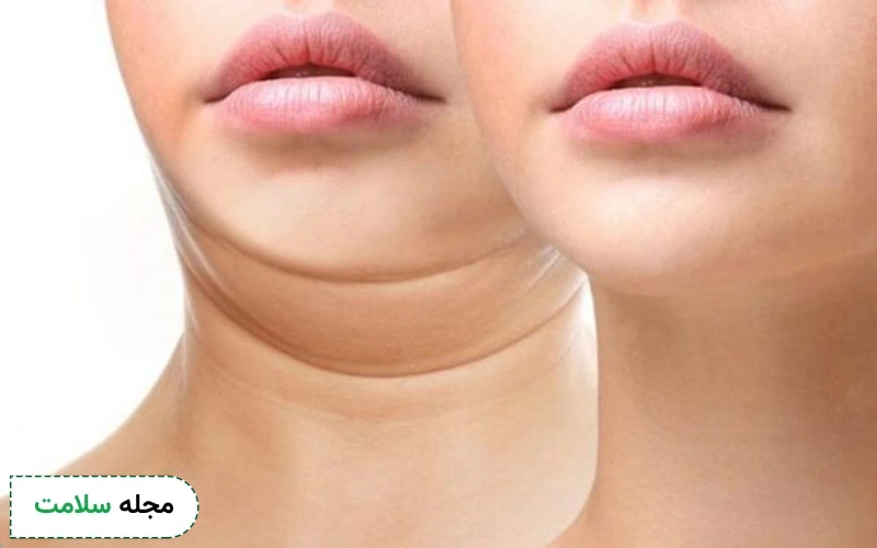 برای زاویه سازی صورت با کیبلا چند جلسه درمان نیاز است؟