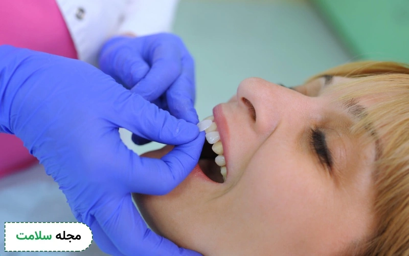 دلایل افتادن لمینت دندان چیست؟ آیا می توان آن را دوباره چسباند؟