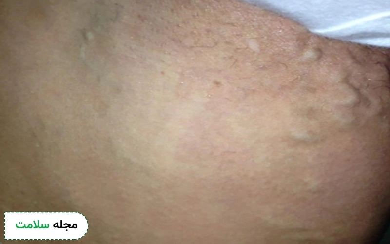 عکس واریس واژن در بارداری
