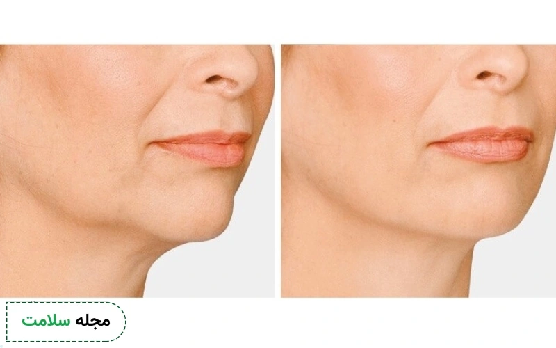 عوارض زاویه سازی فک با پروتز چانه