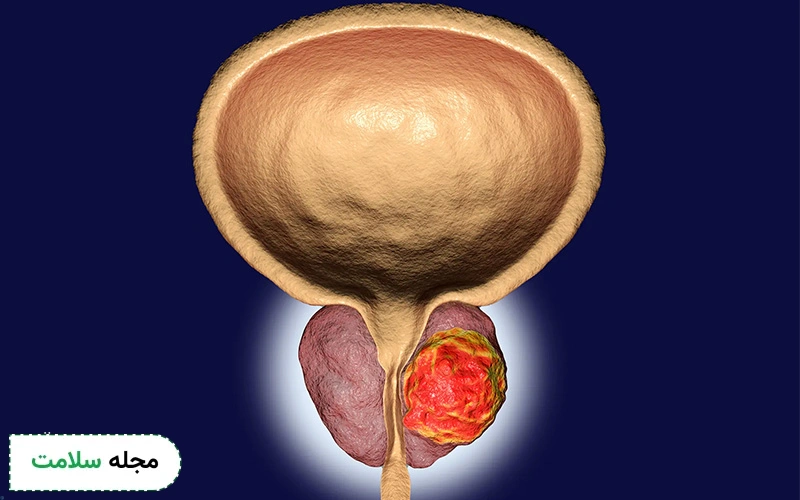 کار پروستات چیست؟