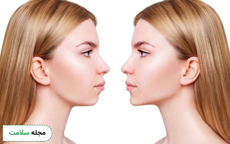 آمادگی های قبل از زاویه سازی فک با جراحی