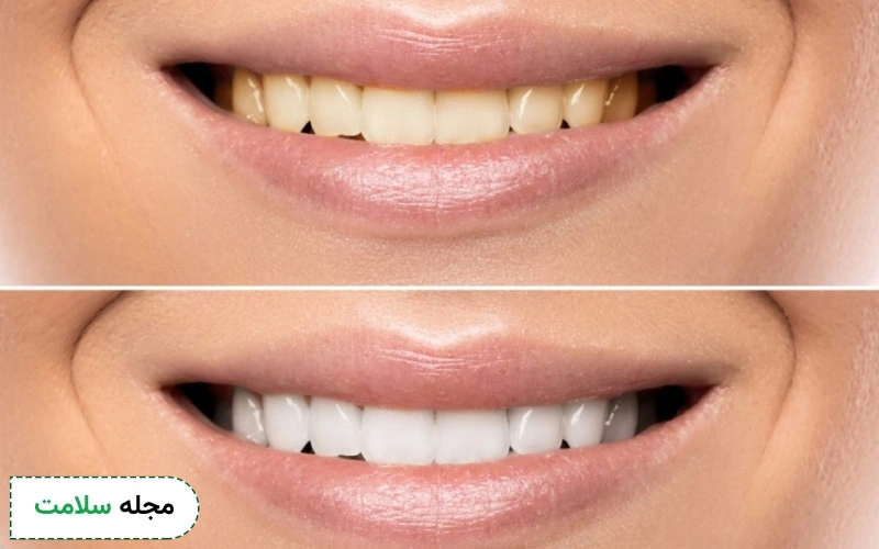 چه نکاتی را بعد از بلیچینگ دندان با لیزر رعایت کنم؟