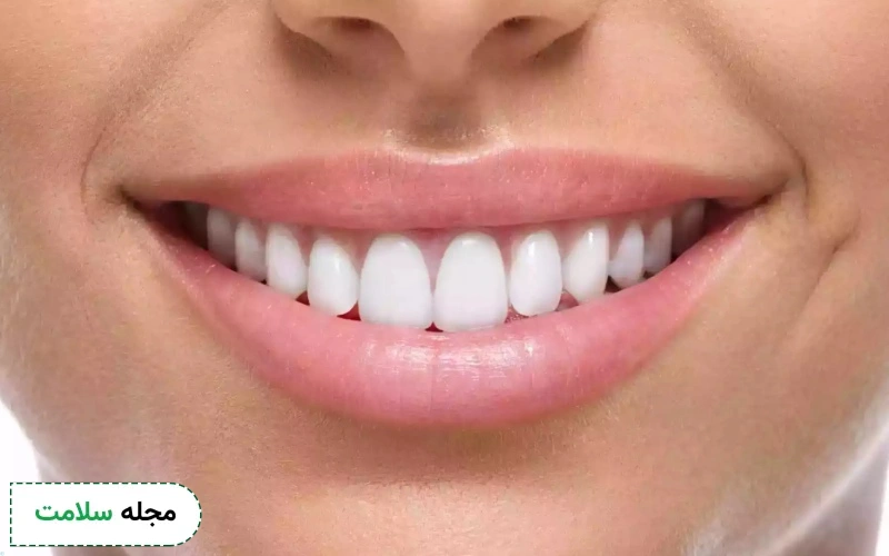 تفاوت لمینت و کامپوزیت چیست؟ 7 فرق این دو روش زیبایی دندان