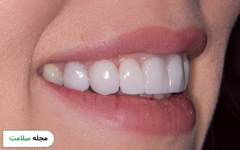 قیمت تعویض لمینت دندان در دکترِتو کلینیک چقدر است؟