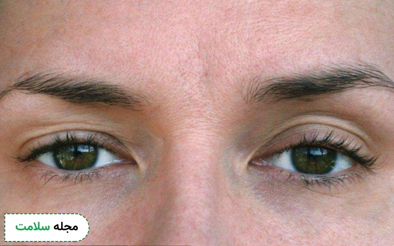 کاشت مژه روسی برای چشم های پف دار