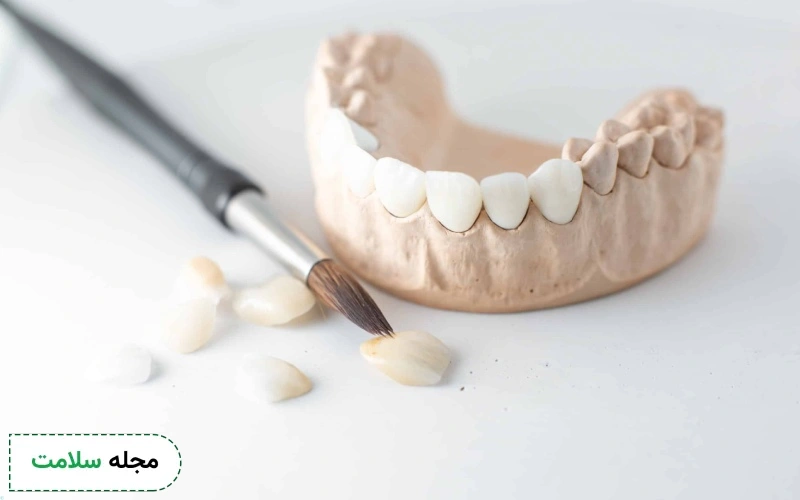 راه های پیشگیری از افتادن لمینت دندان کدامند؟