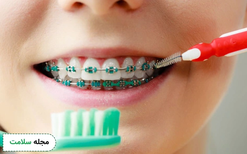 مراقبت های بعد از ارتودنسی مینی اسکرو چیست؟