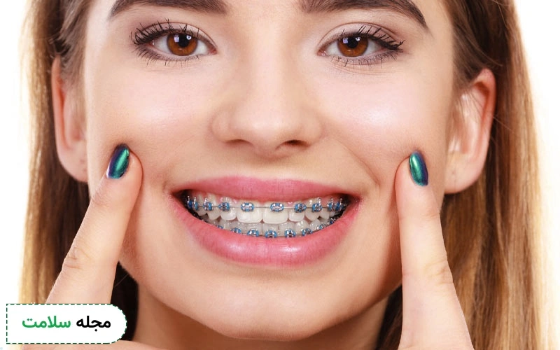 ارتودنسی سنتی برای چه افرادی مناسب است؟ مزایا و معایب آن چیست؟