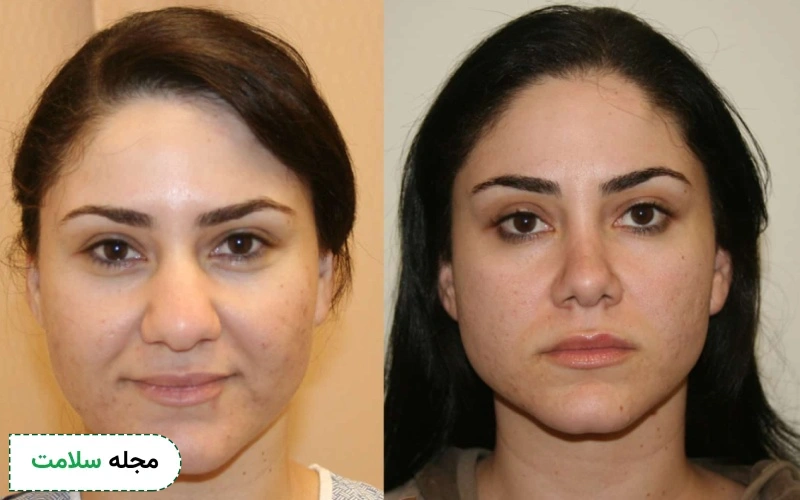 عکس قبل و بعد جراحی بینی گوشتی