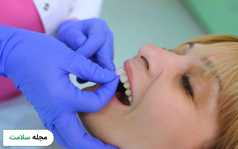 برای جلوگیری از تاثیر سیگار روی لمینت باید به کدام دکتر مراجعه کنیم؟