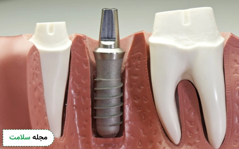 مراحل ایمپلنت فوری دندان چگونه است؟