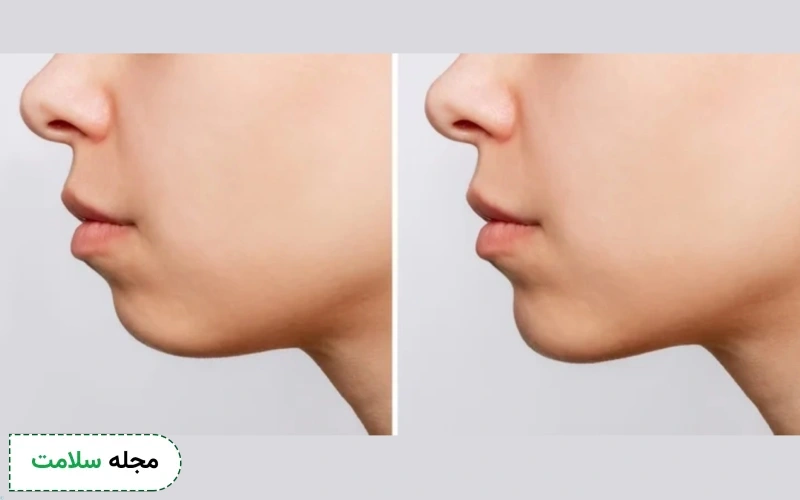 عکس قبل و بعد ژنیوپلاستی