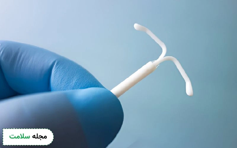 دستگاه آی یو دی هورمونی؛ مزایا، عوارض و نحوه گذاشتن iud