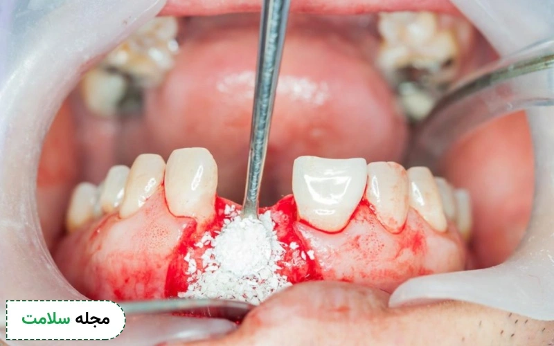عمل پیوند استخوان برای چه افرادی ضروری است؟