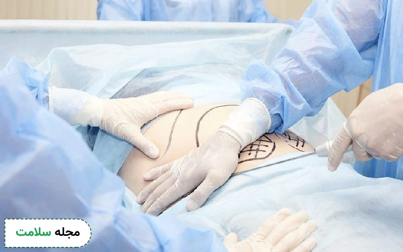 عمل لیپوماتیک چیست و چه عوارضی دارد؟