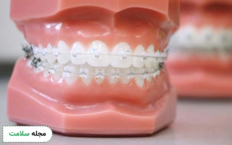 روش انجام ارتودنسی دیمون چگونه است؟