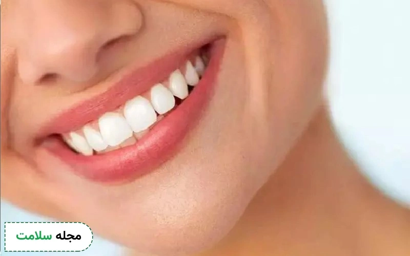 لمینت کامپوزیتی روشی ارزان و سریع برای زیبایی لبخند