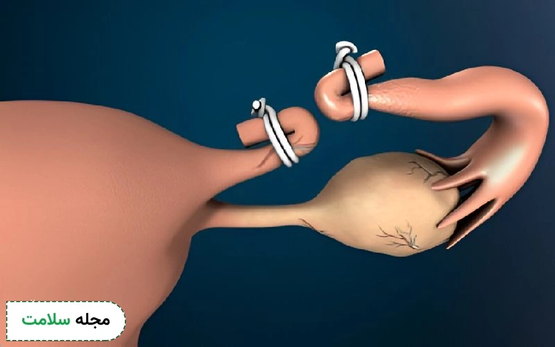 عکس از بستن لوله رحم