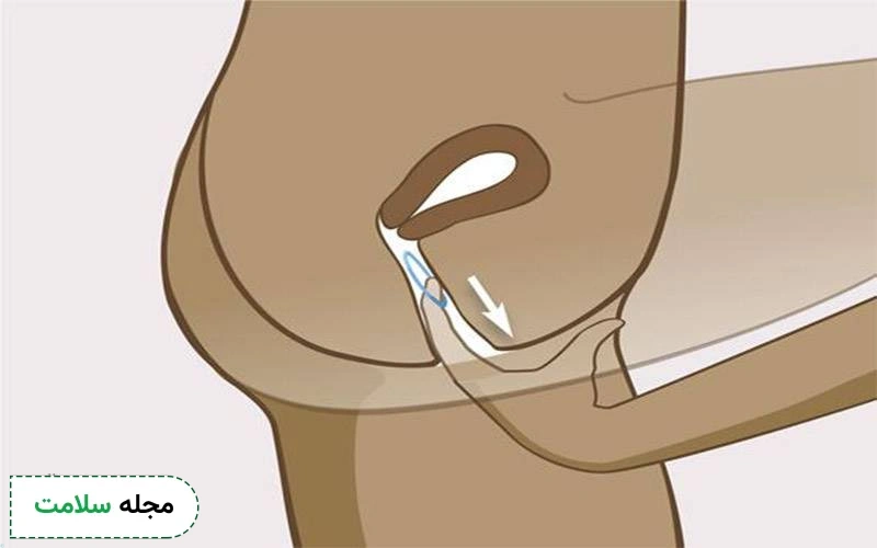 عکس حلقه در رحم
