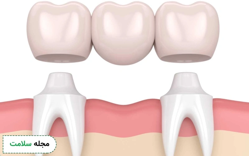 مشکلات و معایب بریج دندان چیست؟