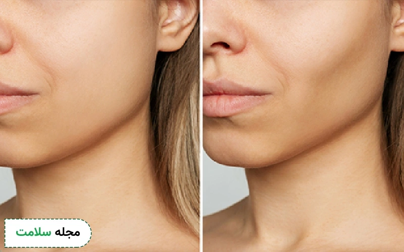 جراحی بوکال فت برای چه کسانی مناسب است؟