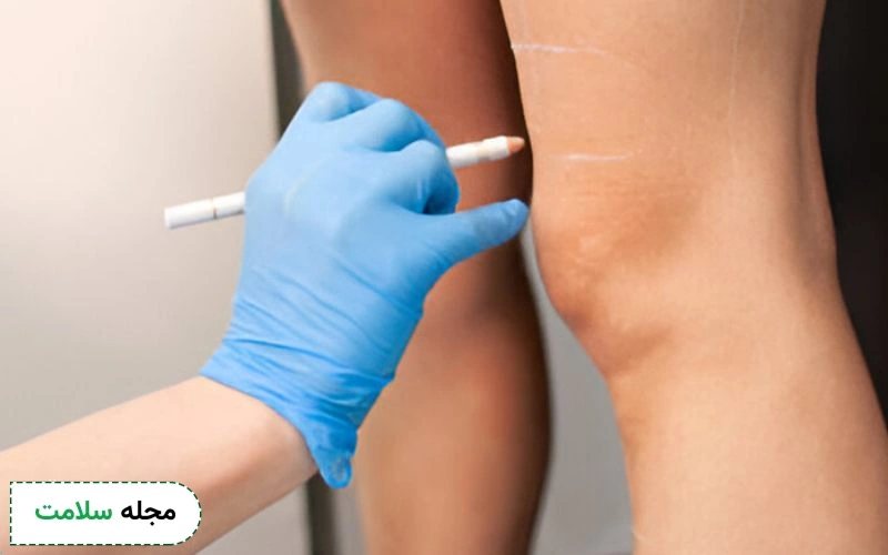 باریکتر و خوشفرمتر شدن زانوها از مزایای لیپوساکشن زانو است.