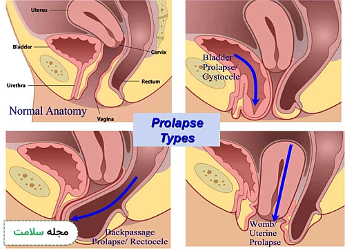 vaginal prolapse types