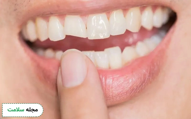 لمینت سرامیکی برای چه کسانی مناسب است