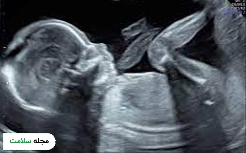 عکس جنین ۱۸ هفته در سونوگرافی