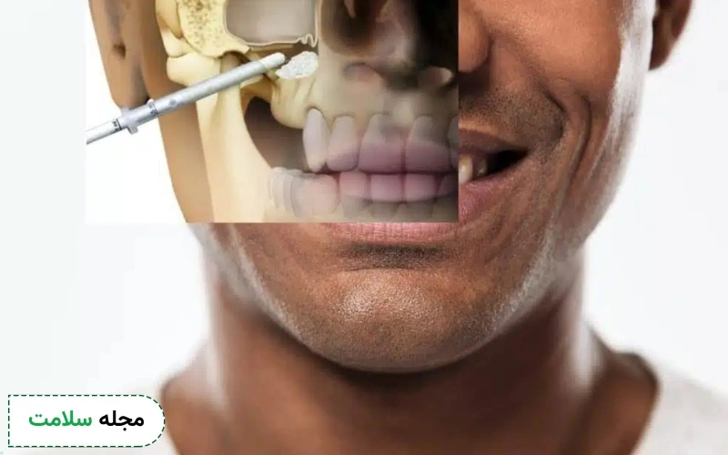 جراحی سینوس لیفت چیست و چه افرادی قبل از ایمپلنت به این جراحی نیاز دارند؟