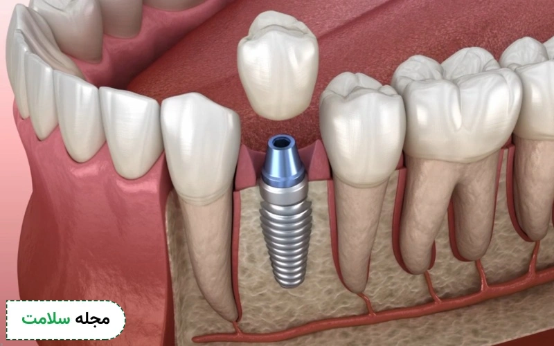 سوراخ شدن بافت اطراف ایمپلنت دندان چه علتی دارد؟