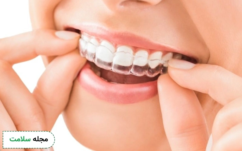 ارتودنسی متحرک چیست و چه تفاوتی با ارتودنسی ثابت دارد؟