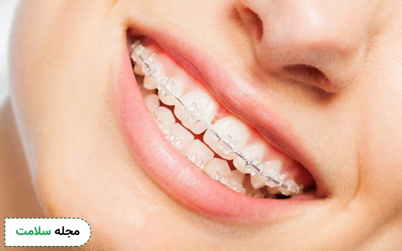 ارتودنسی دیمون، جدیدترین روش ارتودنسی ثابت دندان