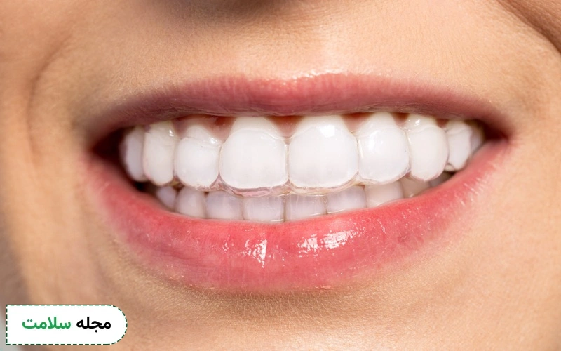 ارتودنسی نامرئی یا اینویزیلاین چیست و چه مزایایی دارند؟