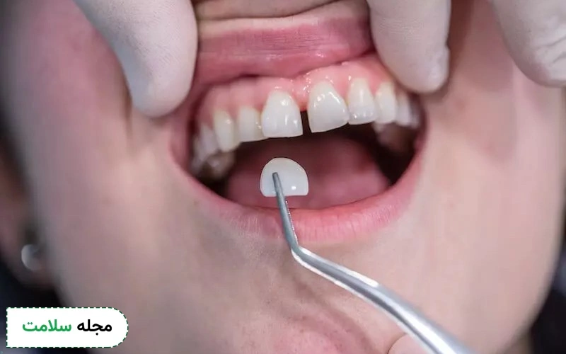 قیمت لمینت سرامیکی