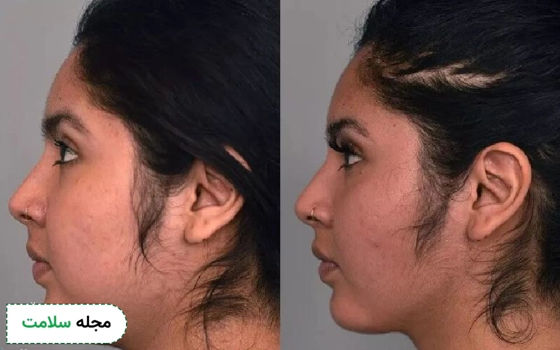 مراقبت های بعد از لیپوساکشن صورت