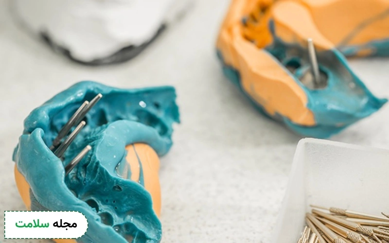 قالب گیری ایمپلنت چگونه و در چه زمانی از کاشت دندان انجام می شود؟