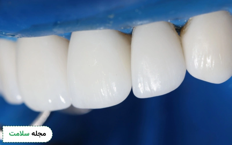 مراحل ساخت و نصب لمینت بدون تراش چگونه است؟